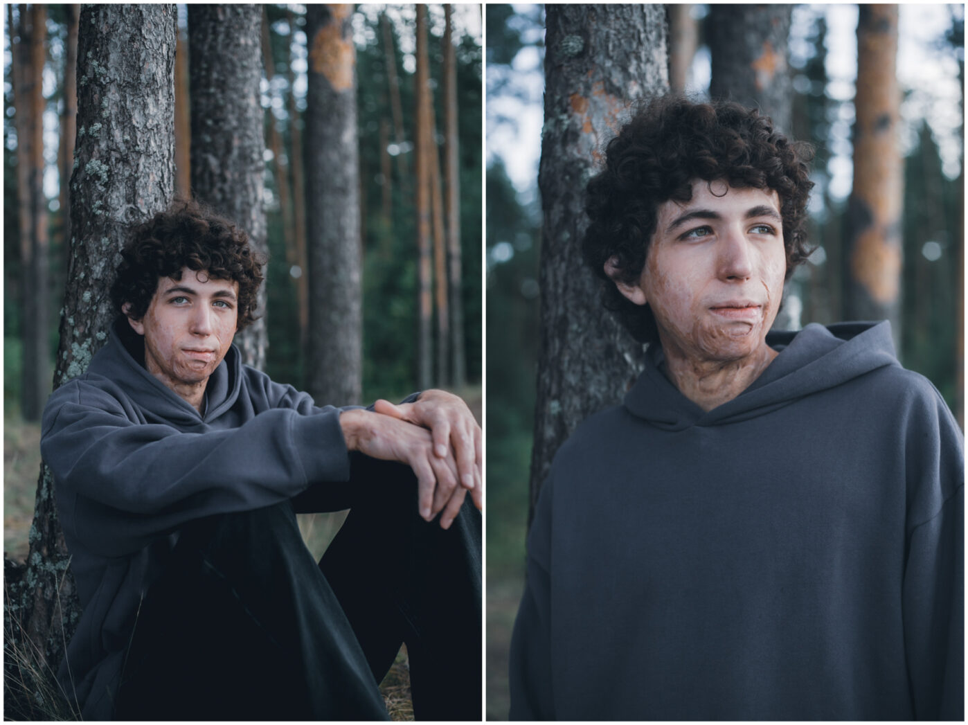 В&nbsp;Ярославской области работает единственный в&nbsp;России лагерь для детей с&nbsp;ожогами. Его организовал фонд «Детская больница» при больнице имени Сперанского